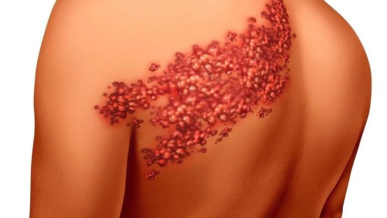 Shingles: Sudden Skin Pain Could Be a Serious Warning Sign! Learn About the Causes and Symptoms