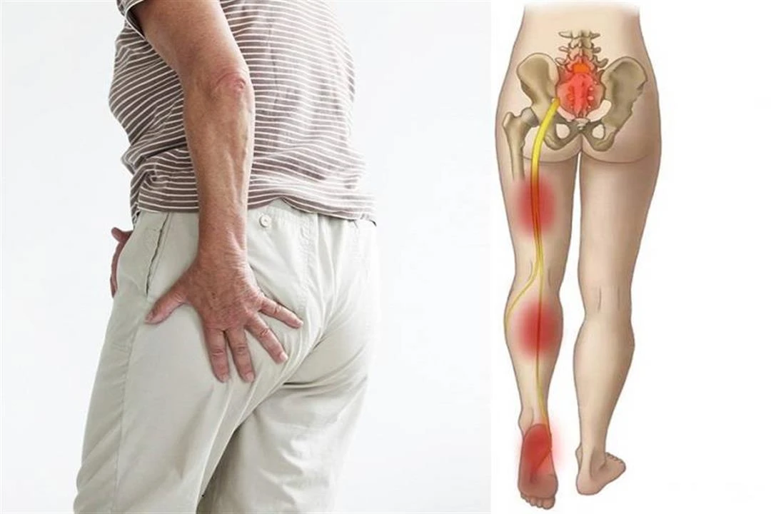 Best Doctor for Sciatica Treatment in the UAE