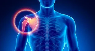 Shoulder joint arthritis