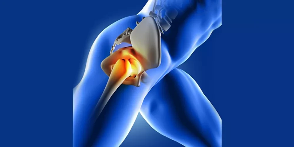 Hip joint arthritis