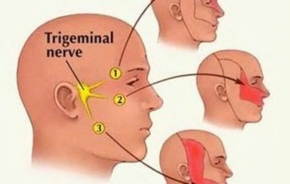 Trigeminal nerve treatment